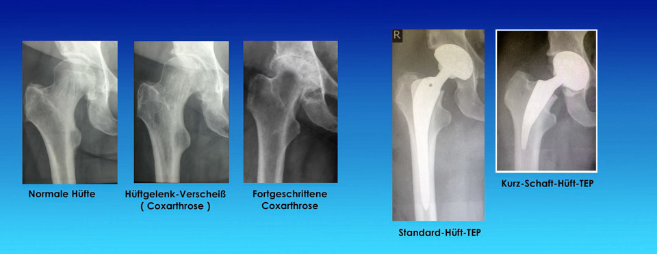 Hüftgelenkarthrose
